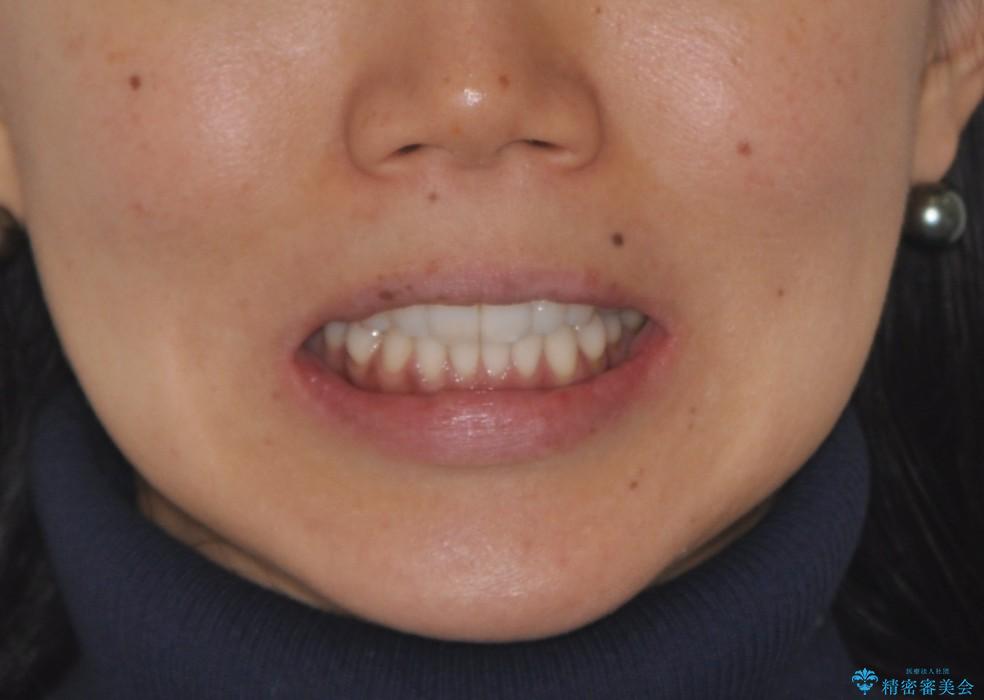 前歯の出っ歯とでこぼこをインビザラインで改善の治療後（顔貌）