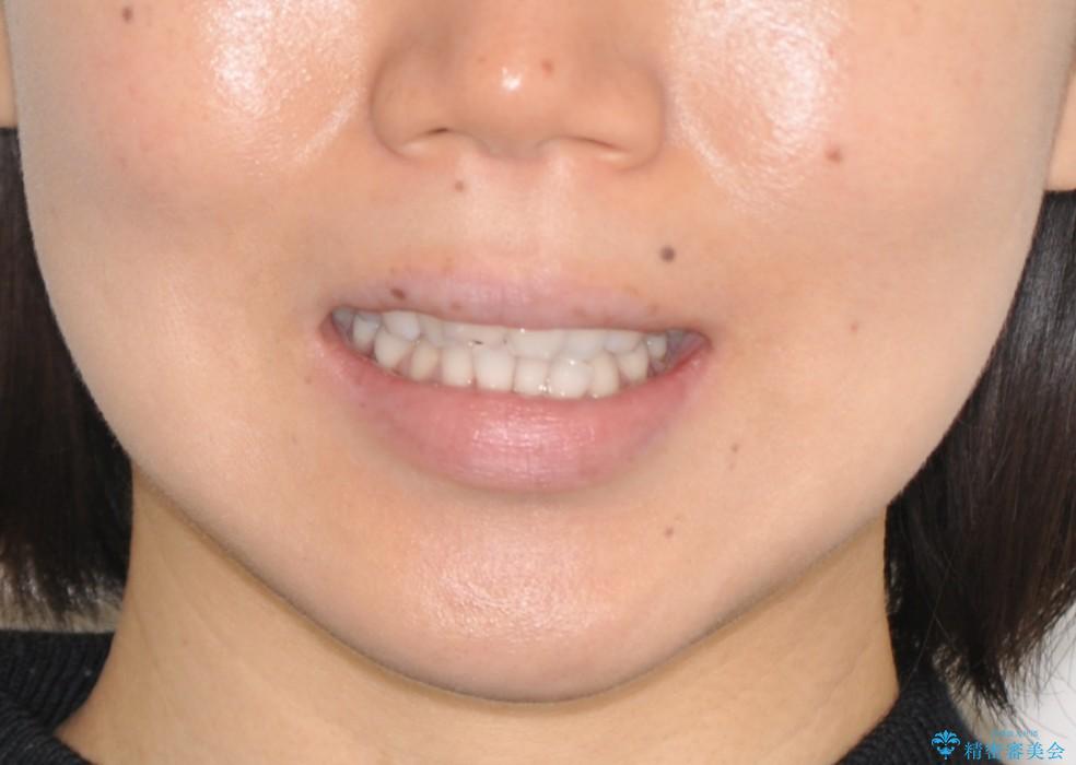 前歯の出っ歯とでこぼこをインビザラインで改善の治療前（顔貌）