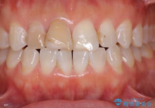 変色した前歯をオールセラミッククラウンに　下の前歯も一緒に部分矯正の治療前