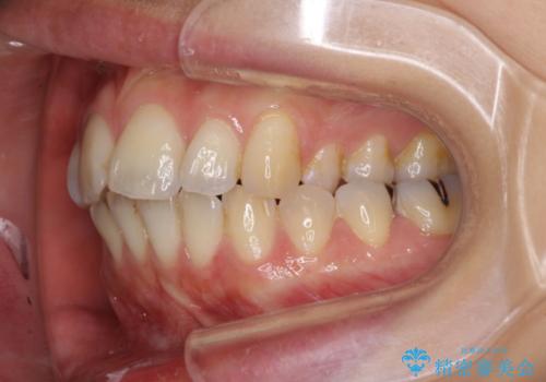 出産しながらでも綺麗な歯並びに　インビザラインによる矯正治療の治療前