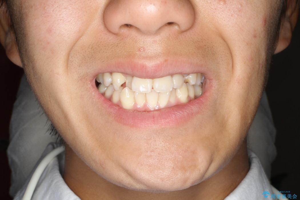 前歯のガタガタを改善　八重歯も無くなりキレイな歯並びにの治療前（顔貌）