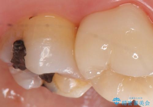 PGA(ゴールド)インレー　古い銀歯の修復の治療前