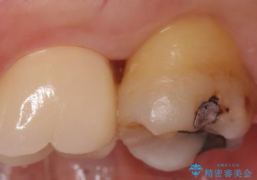 PGA(ゴールド)インレー　古い銀歯の修復の治療前