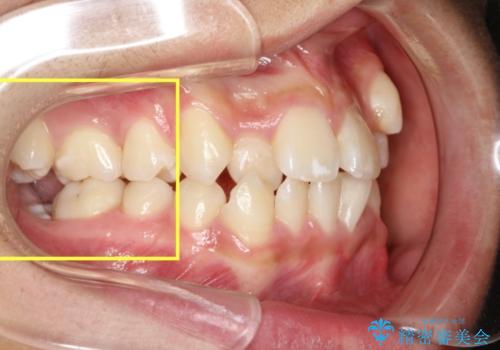 全顎矯正治療の部分的な紹介 ～横向きに生えた奥歯を整直させる～の治療前