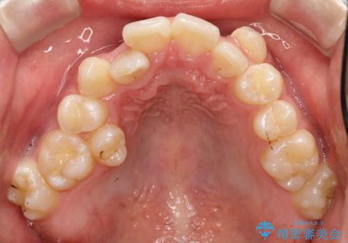 前歯のガタガタを改善　八重歯も無くなりキレイな歯並びにの治療前