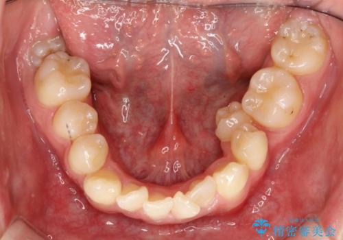 前歯のガタガタを改善　八重歯も無くなりキレイな歯並びにの治療前