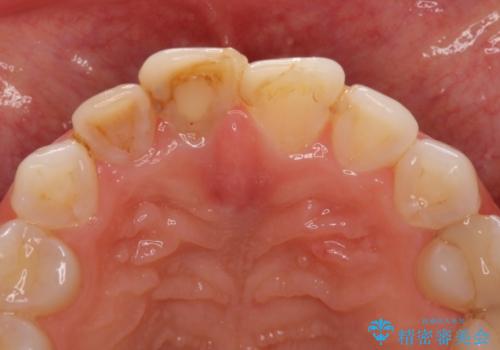 変色した前歯をオールセラミッククラウンに　下の前歯も一緒に部分矯正の治療前