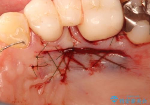 矯正治療後の歯肉退縮　歯肉移植による根面被覆の治療後