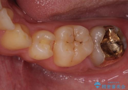 小さい虫歯　歯にやさしいゴールドインレーの治療中