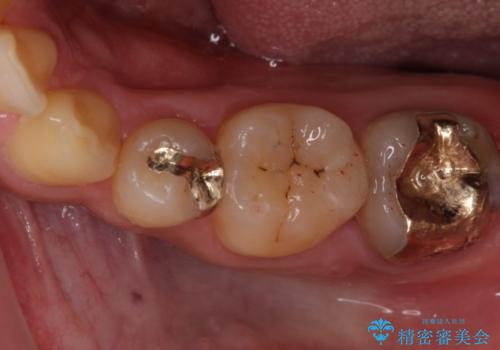 小さい虫歯　歯にやさしいゴールドインレーの治療後