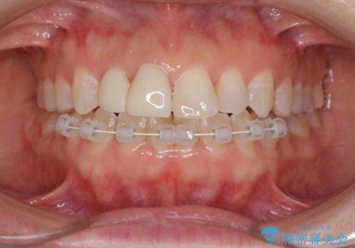 変色した前歯をオールセラミッククラウンに　下の前歯も一緒に部分矯正の治療中