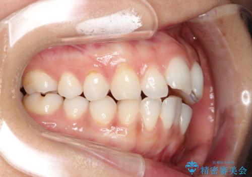 前歯の出っ歯とでこぼこをインビザラインで改善の治療前