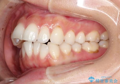 前歯の出っ歯とでこぼこをインビザラインで改善の治療前