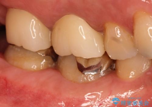 金属の詰め物の下に虫歯が　オールセラミッククラウンによる虫歯治療の治療後