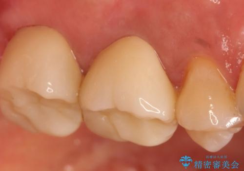 金属の詰め物の下に虫歯が　オールセラミッククラウンによる虫歯治療の治療後