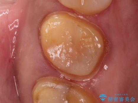 金属の詰め物の下に虫歯が　オールセラミッククラウンによる虫歯治療の治療中