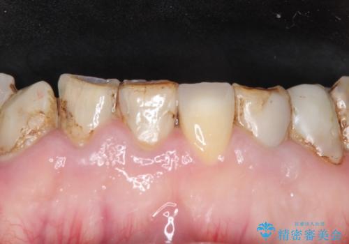 前歯2本のオールセラミッククラウン　根管治療後の補綴の治療前