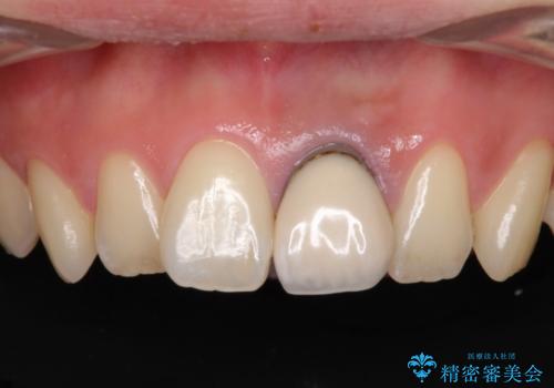 歯肉のラインが汚れている前歯　セラミックによる審美治療