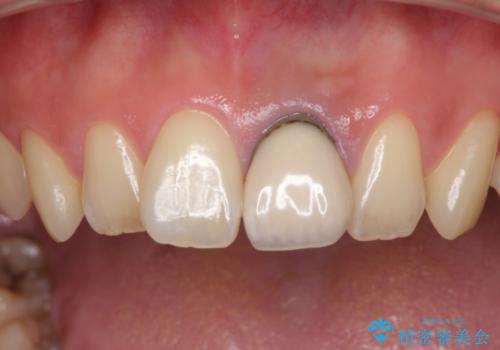 歯肉のラインが汚れている前歯　セラミックによる審美治療の治療前