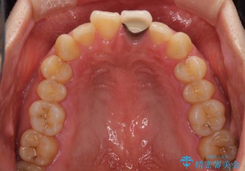 歯肉のラインが汚れている前歯　セラミックによる審美治療の治療前