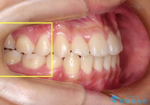 全顎矯正治療の部分的な紹介 ～横向きに生えた奥歯を整直させる～の治療後