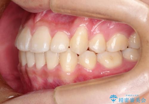 前歯のガタガタを改善　八重歯も無くなりキレイな歯並びにの治療後
