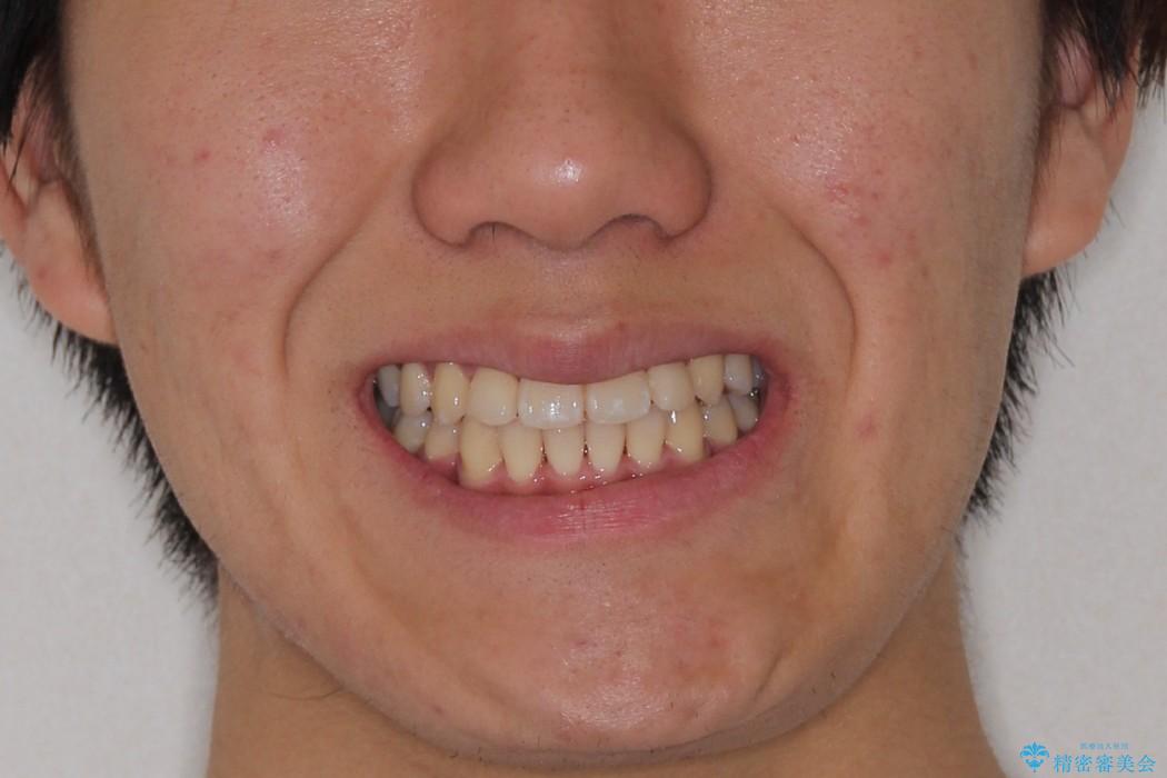 前歯のガタガタを改善　八重歯も無くなりキレイな歯並びにの治療後（顔貌）