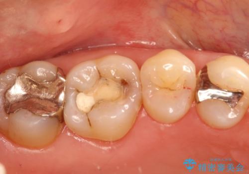 セラミックインレー 天然の歯に近い透明感や色調を再現するの治療前
