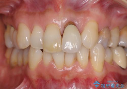 前歯の茶色い縁を綺麗にしたい　前歯のオールセラミックの治療前