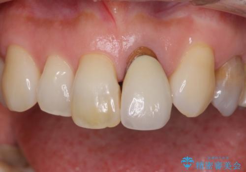 前歯の茶色い縁を綺麗にしたい　前歯のオールセラミックの治療前