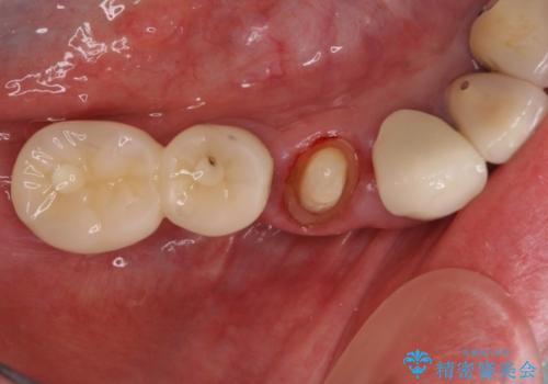 汚れがたまって気になる　歯ぐきとの境目から虫歯の治療中