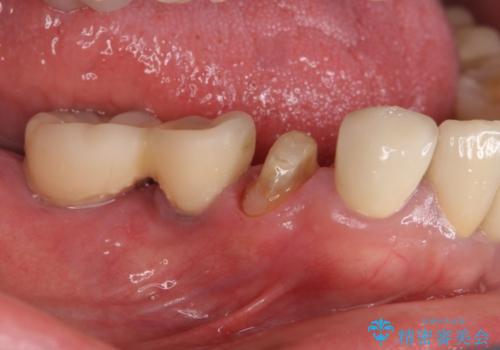 汚れがたまって気になる　歯ぐきとの境目から虫歯の治療中