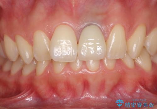 歯肉のラインが汚れている前歯　セラミックによる審美治療の治療後