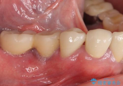 汚れがたまって気になる　歯ぐきとの境目から虫歯の治療後