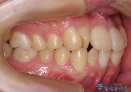 前歯のねじれ　下の歯のガタガタの治療前