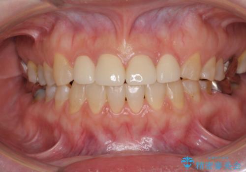 隙間の空いた前歯を治したい　部分矯正とオールセラミッククラウンの治療後