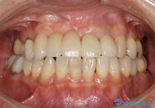 前歯のブリッジの再製作　根管治療からやり直すの治療後
