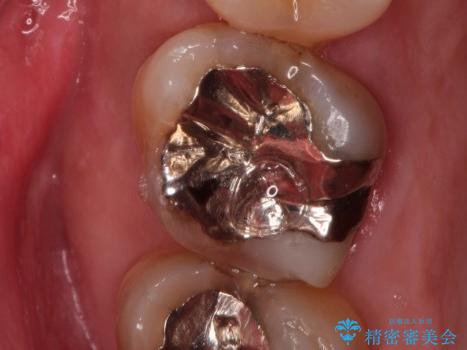 金属の詰め物の下に虫歯が　オールセラミッククラウンによる虫歯治療の治療前