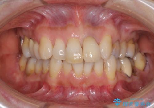 前歯の茶色い縁を綺麗にしたい　前歯のオールセラミックの治療後