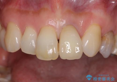 前歯の茶色い縁を綺麗にしたい　前歯のオールセラミックの治療後