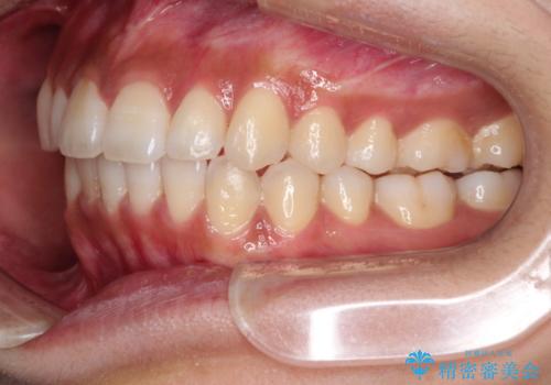 インビザラインで前歯のガタガタを改善の治療後