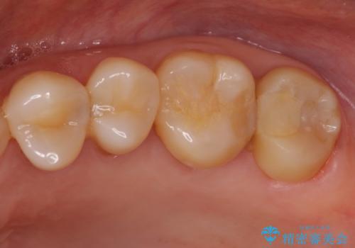 奥歯が痛い　ゴールドクラウンによる補綴治療の治療前