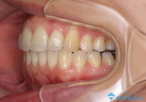 出産しながらでも綺麗な歯並びに　インビザラインによる矯正治療の治療後