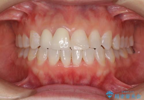 変色した前歯をオールセラミッククラウンに　下の前歯も一緒に部分矯正の治療後