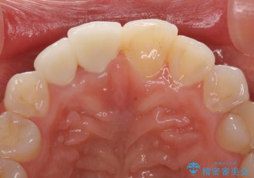 変色した前歯をオールセラミッククラウンに　下の前歯も一緒に部分矯正の治療後