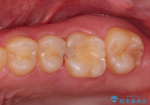 虫歯の再発　セラミックインレー修復の治療前