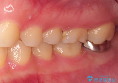 虫歯の再発　セラミックインレー修復の治療前