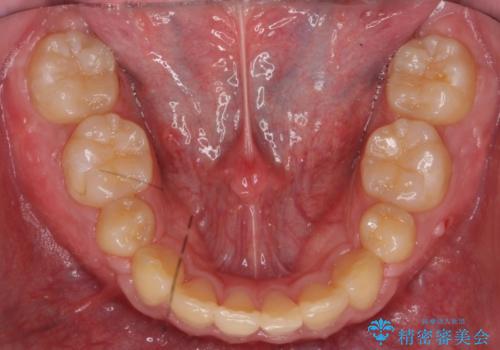 前歯のねじれ　下の歯のガタガタの治療後