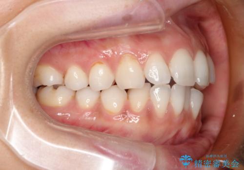 前歯の出っ歯とでこぼこをインビザラインで改善の治療中