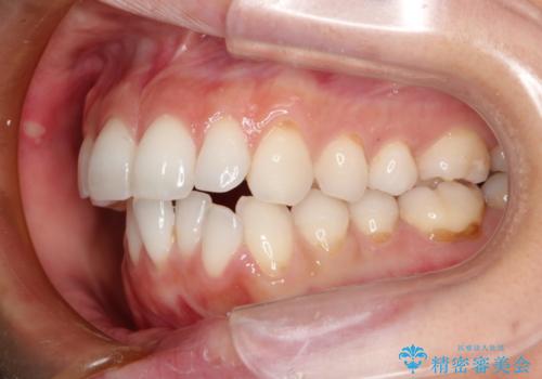 前歯の出っ歯とでこぼこをインビザラインで改善の治療中